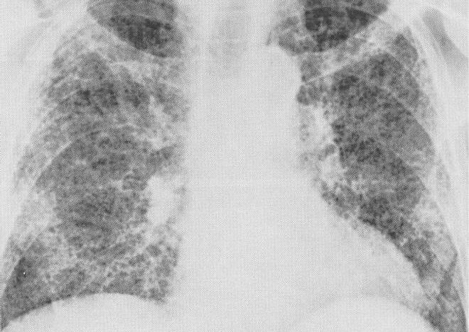 El Hospital de Bellvitge desarrolla una IA que diagnostica con rapidez la fibrosis pulmonar y predice su evolución