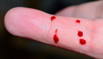 Llega a España concizumab, la primera terapia para todos los tipos de hemofilia que padecen 3.000 españoles