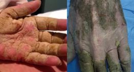 ¿Qué es la sarna noruega que está afectando a más de 30 personas en Galicia? ¿Tiene cura?