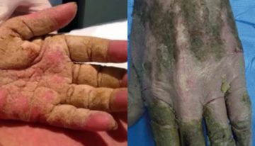 ¿Qué es la sarna noruega que está afectando a más de 30 personas en Galicia? ¿Tiene cura?