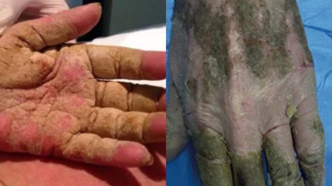 ¿Qué es la sarna noruega que está afectando a más de 30 personas en Galicia? ¿Tiene cura?