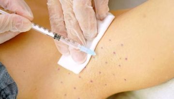 Hasta el 3% de la población sufre hiperhidrosis, el exceso de sudor que trastoca la vida: «Es un problema médico real y tratable»