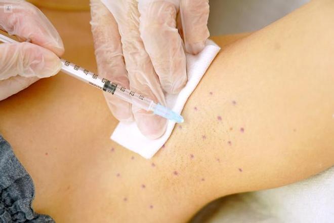 Hasta el 3% de la población sufre hiperhidrosis, el exceso de sudor que trastoca la vida: «Es un problema médico real y tratable»