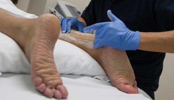 Un equipo médico de Barcelona regenera el tendón de Aquiles sin cirugía mediante células madre cultivadas: «Permite al paciente andar sin yesos ni férulas»