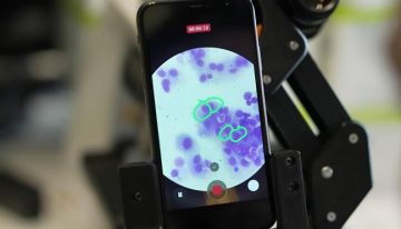 Un estudio advierte de que el uso de antibióticos reduce un 20% la supervivencia en pacientes con mieloma múltiple tratados con inmunoterapia