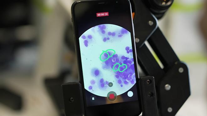 Un estudio advierte de que el uso de antibióticos reduce un 20% la supervivencia en pacientes con mieloma múltiple tratados con inmunoterapia