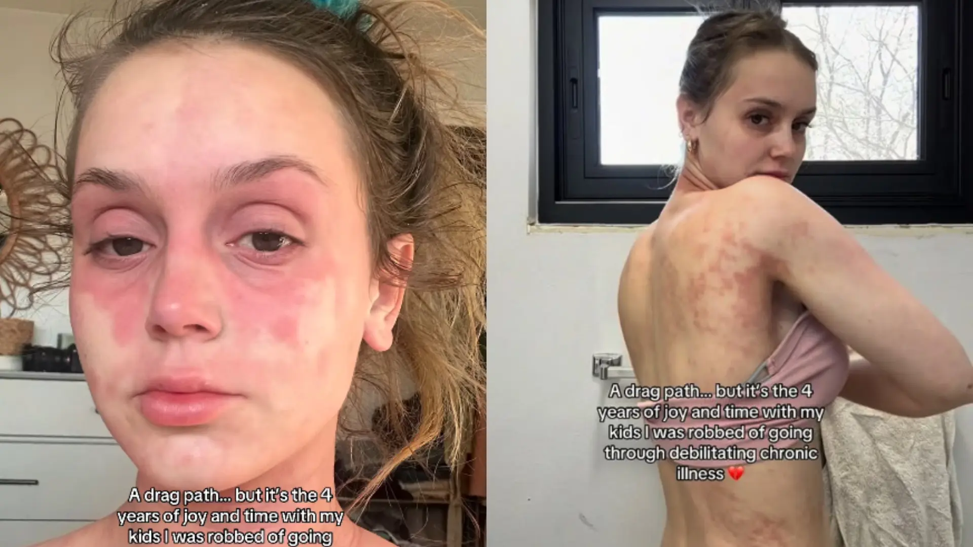 La 'influencer' Mikayla Matthews muestra la peor cara de su extraña enfermedad en la piel: «Puede quitarte las ganas de vivir»