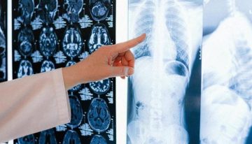 Una terapia oral diaria muestra resultados «extraordinarios» en cáncer de pulmón avanzado