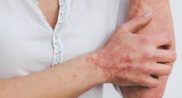 El fármaco risankizumab se asocia con una mejora en los pacientes con psoriasis