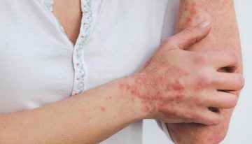 El fármaco risankizumab se asocia con una mejora en los pacientes con psoriasis