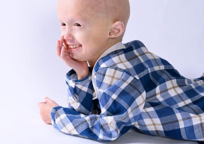 Seis claves de la progeria, la enfermedad ultrarrara que sufre la niña Alexandra Peraut y que provoca vejez prematura