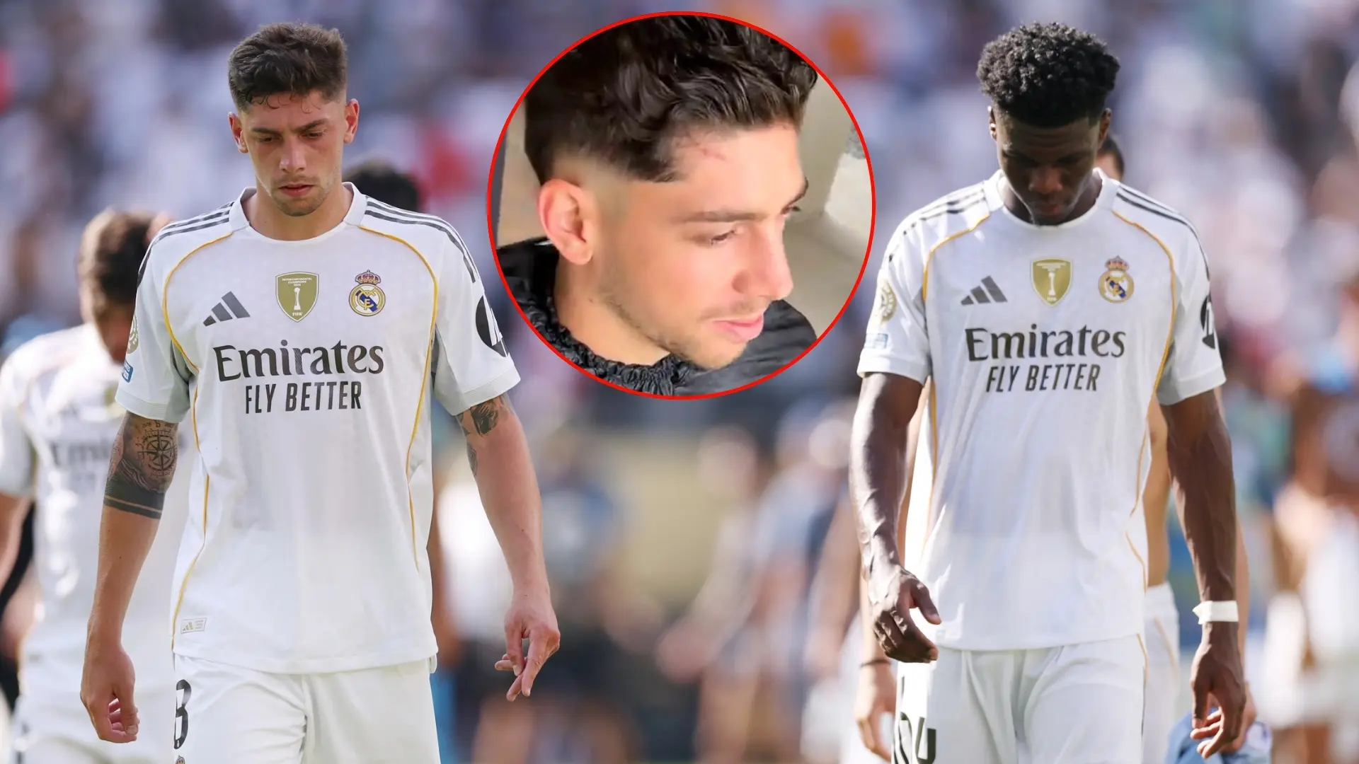 Primera imagen de la cicatriz de Fede Valverde tras su pelea con Tchouaméni