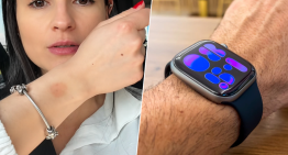 Llevamos el Apple Watch tantas horas que ya hay un nombre para el problema que puede provocar en la piel: «watch rot»