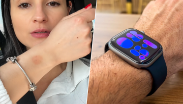 Llevamos el Apple Watch tantas horas que ya hay un nombre para el problema que puede provocar en la piel: «watch rot»
