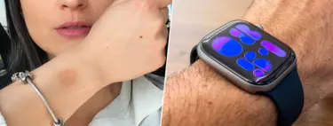 "Es un problema frecuente". Los dermatólogos avisan del problema silencioso de los Apple Watch en la piel