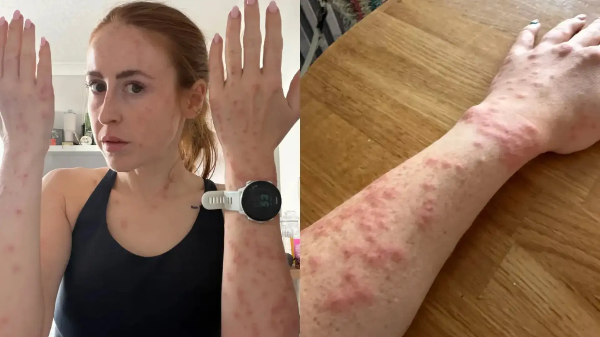 La terrible experiencia de una 'influencer' de viajes en un hotel infestado de chinches: «Me desperté con picazón»