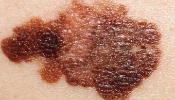 Las claves del melanoma, el cáncer de piel más agresivo con una vacuna en el horizonte