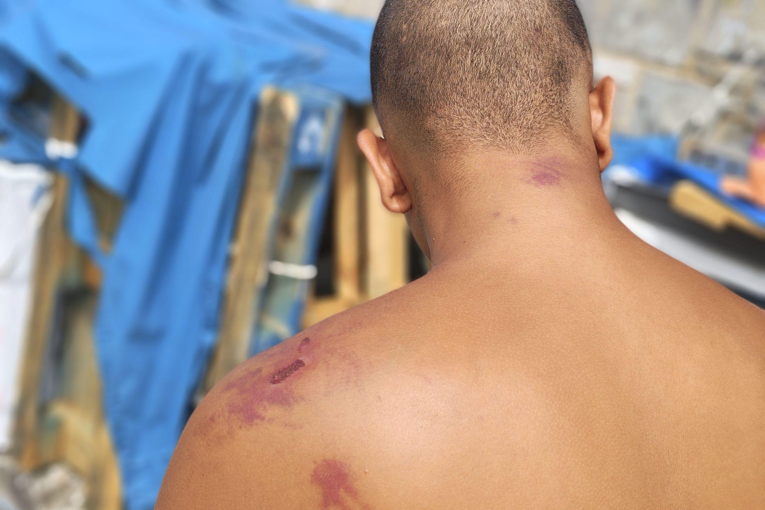 Moratones y magulladuras en el cuerpo de un migrante en Ceuta.