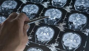 Los hospitales de Can Ruti y Sant Pau representarán a España en un gran estudio europeo sobre una prometedora cirugía para el alzhéimer