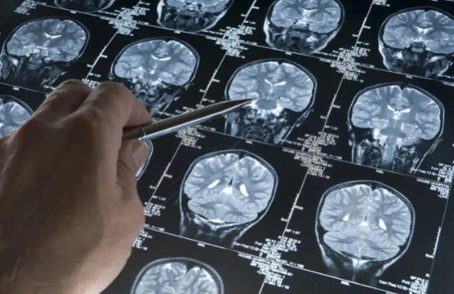 Los hospitales de Can Ruti y Sant Pau representarán a España en un gran estudio europeo sobre una prometedora cirugía para el alzhéimer