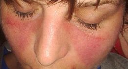 Vall d'Hebron investiga una crema contra el lupus cutáneo que ha reducido un 90% las lesiones en estudios preliminares