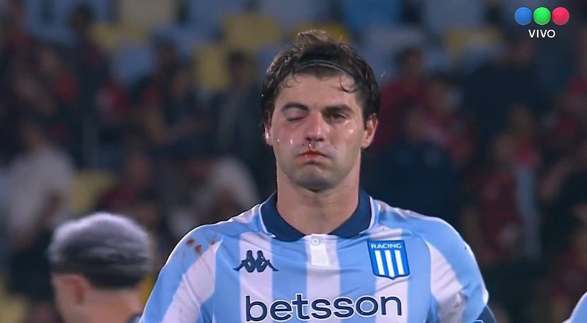 Santiago Sosa reapareció en público y mostró cómo le quedó el rostro tras la operación de la fractura que le provocó Rojo