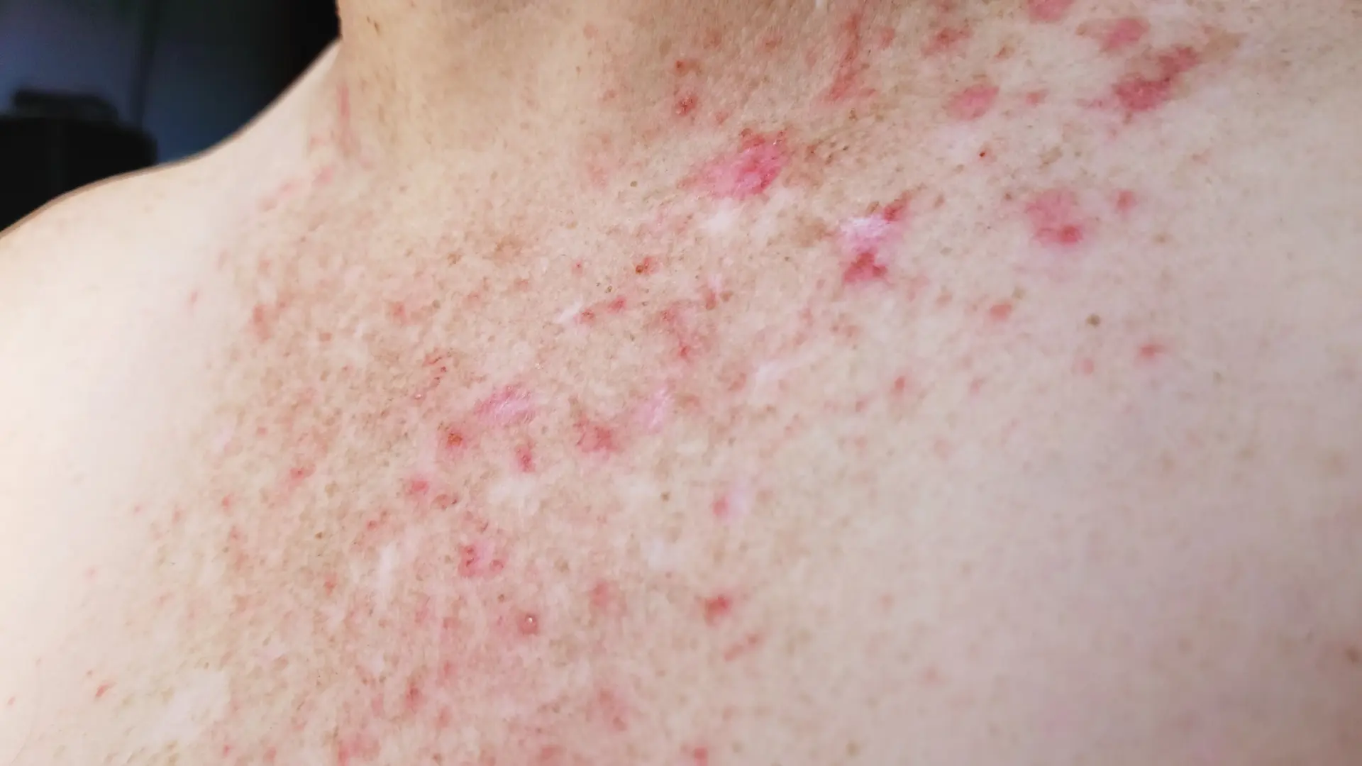 Ni es contagiosa, ni solo afecta a la piel: desmontamos cinco creencias erróneas sobre la psoriasis