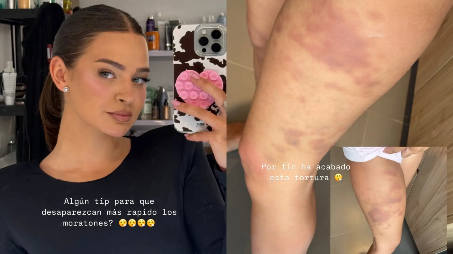 Laura Escanes muestra una preocupante foto de sus piernas amoratadas y pide ayuda: "¿Algún tip para que desaparezcan rápido?"