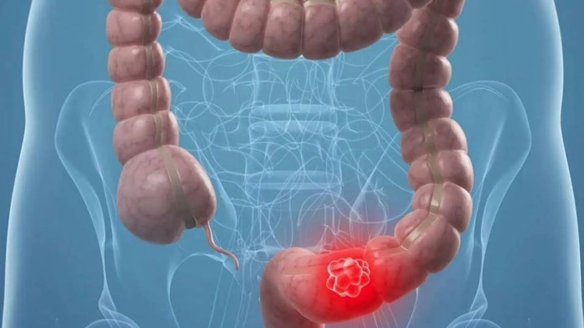 Desarrollan una biopsia líquida que detecta el cáncer colorrectal en fase inicial: tiene un 95% de éxito