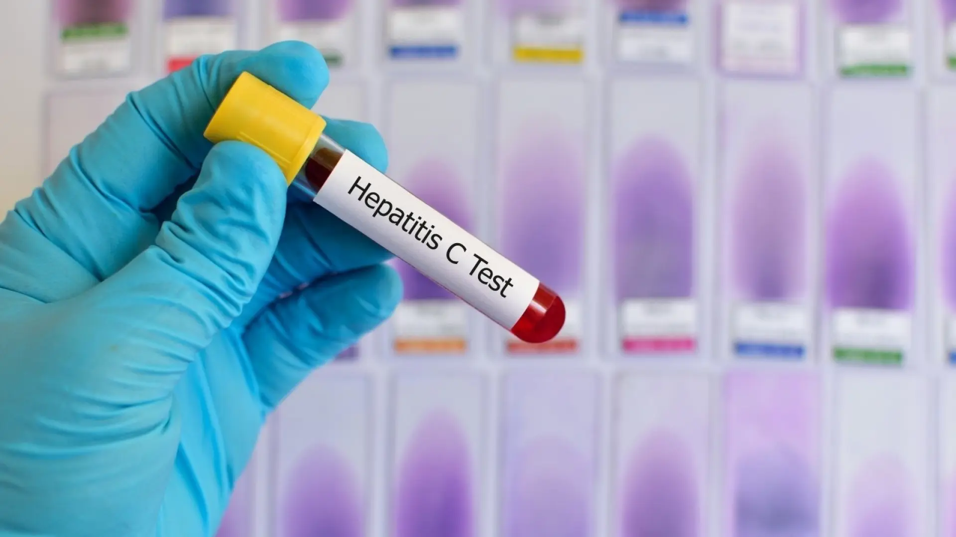 España, a falta de un impulso final para ser el primer país en eliminar la hepatitis C