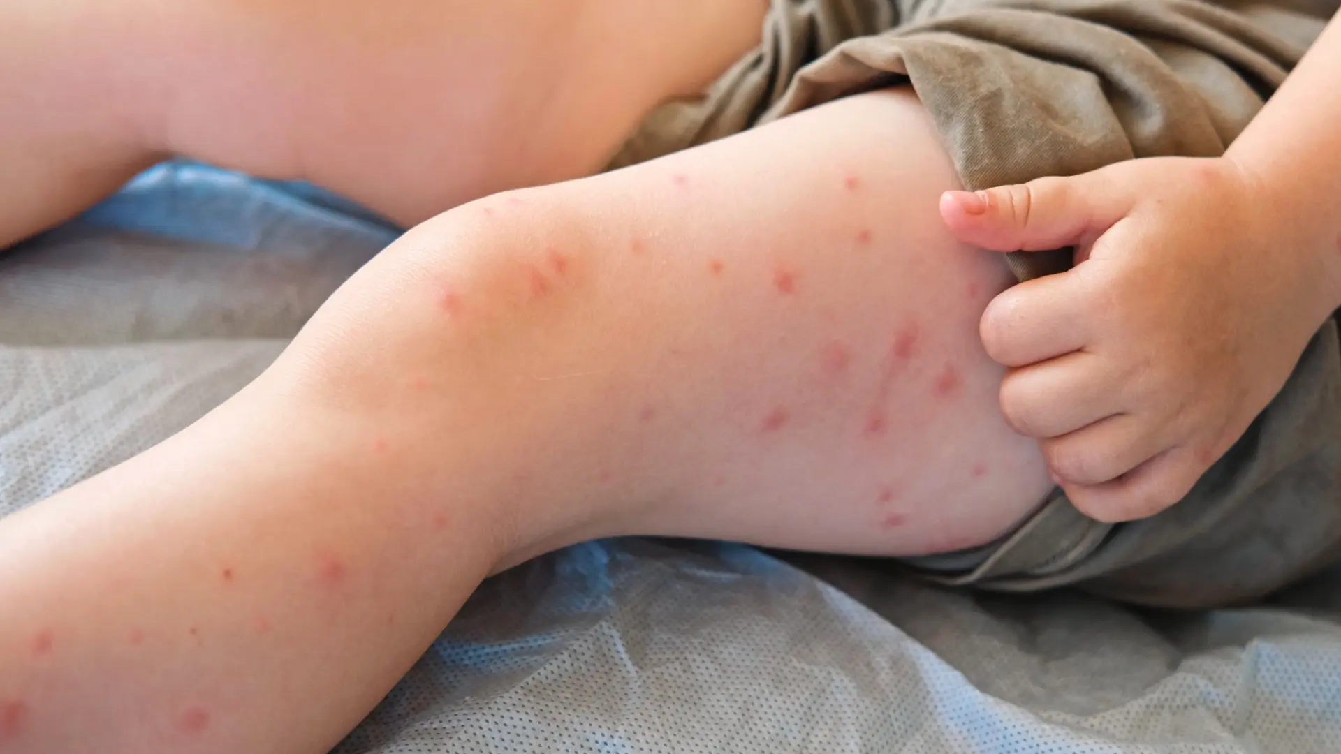 Estos son las países más afectados por el brote de sarampión