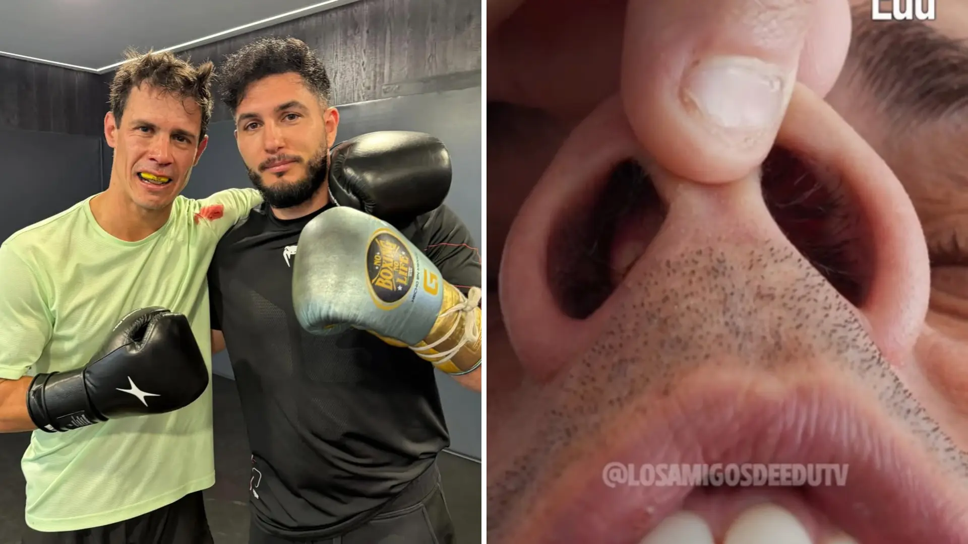 Edu Aguirre enseña cómo está su nariz tras ser noqueado por Omar Montes preparándose para la Velada del Año 6: «No me entra el aire»