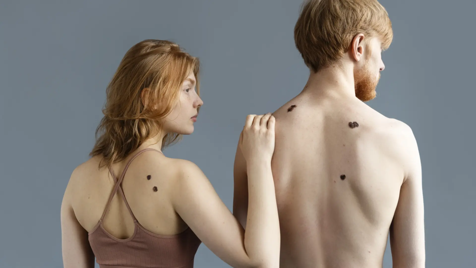 La AECC asegura que vigilar los lunares y manchas en la piel es el mejor control de los melanomas