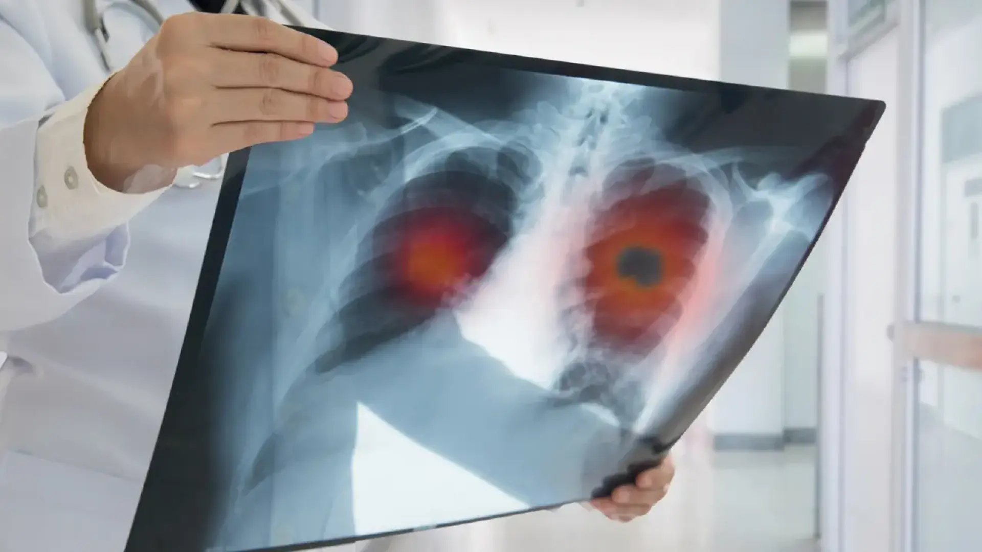 Esperanza frente al cáncer de pulmón avanzado: un fármaco experimental casi duplica la supervivencia