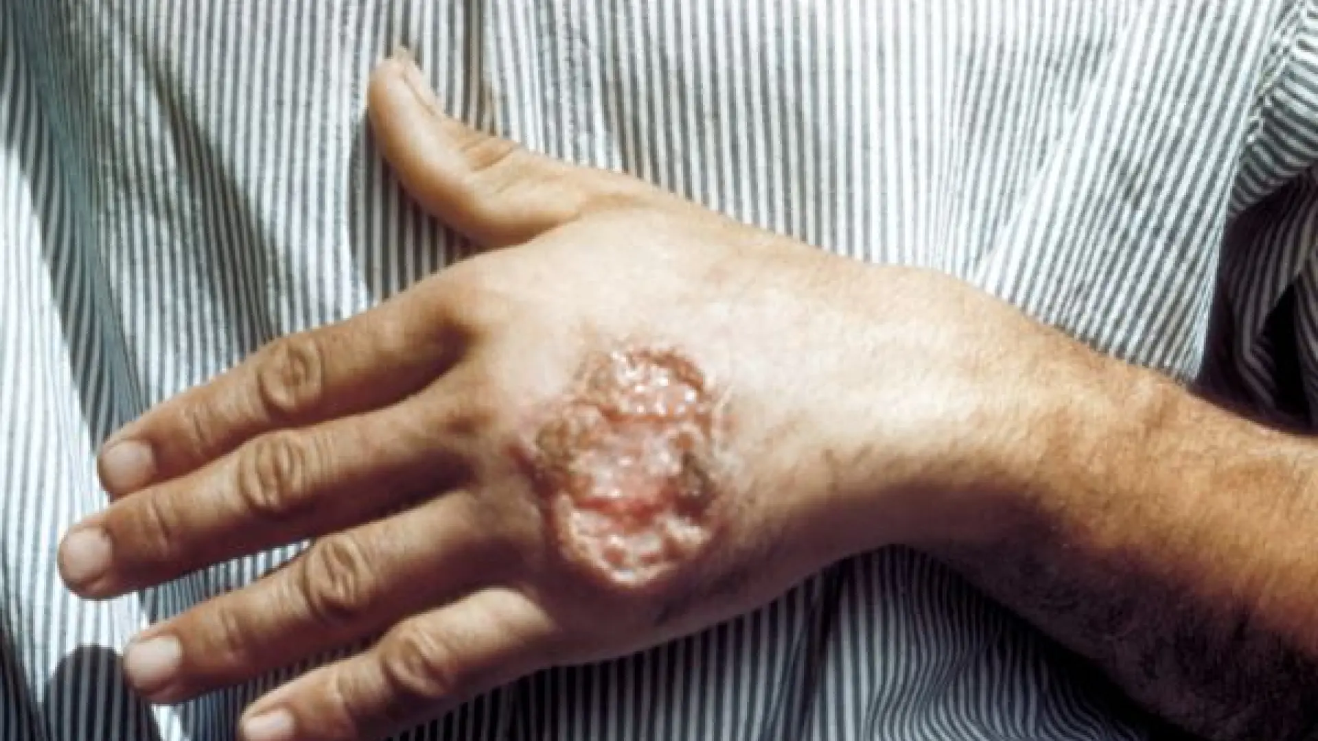 Probado con éxito en ratones un nuevo tratamiento para la leishmaniosis cutánea