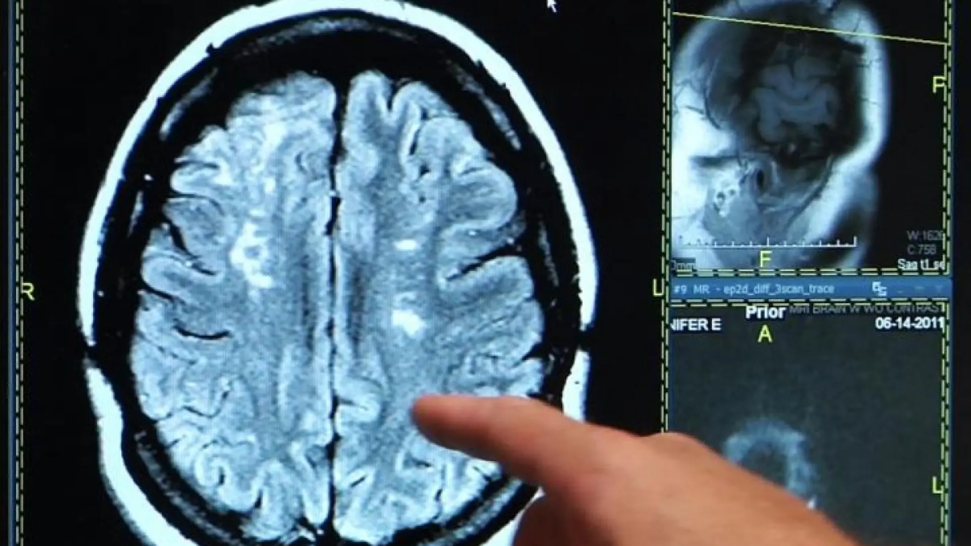 El cerebro podría convertirse en el peor enemigo tras sufrir un ictus