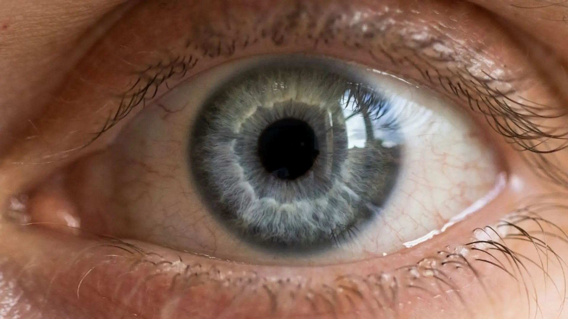 Los médicos descubren un enorme clavo de 35 milímetros dentro del ojo de un hombre que había perdido la visión