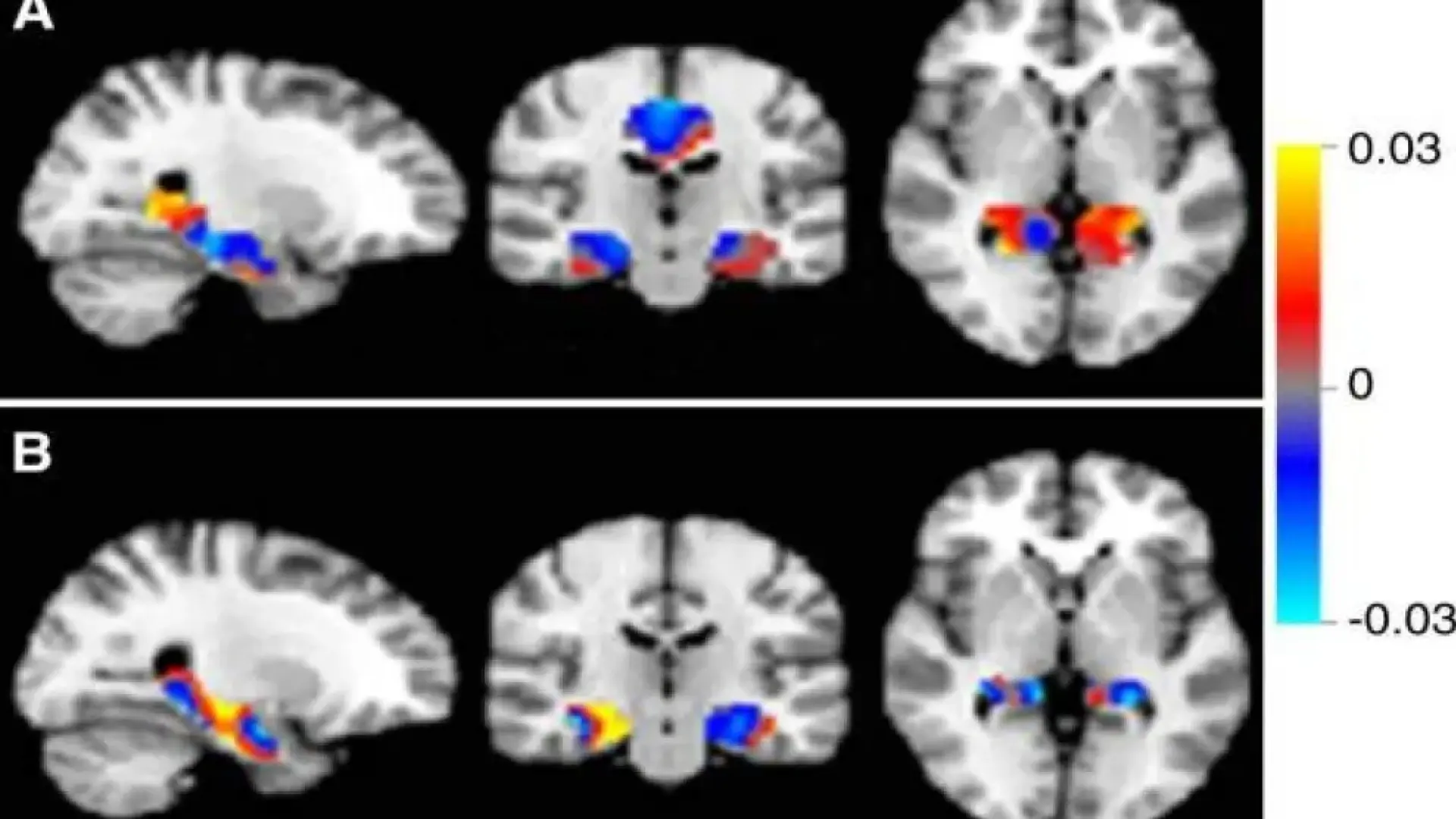 Una terapia no invasiva potencia el sistema de limpieza del cerebro y muestra beneficios frente al alzhéimer