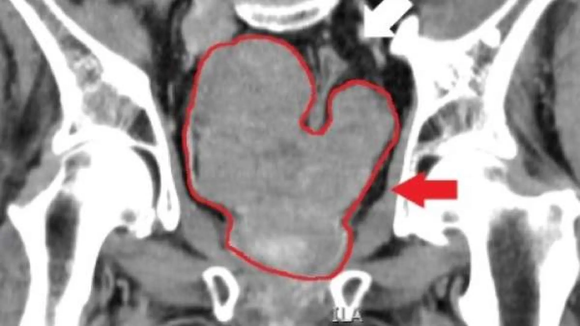 Los cambios en tu alimentación que debes aplicar para reducir el riesgo de cáncer de próstata, según un estudio