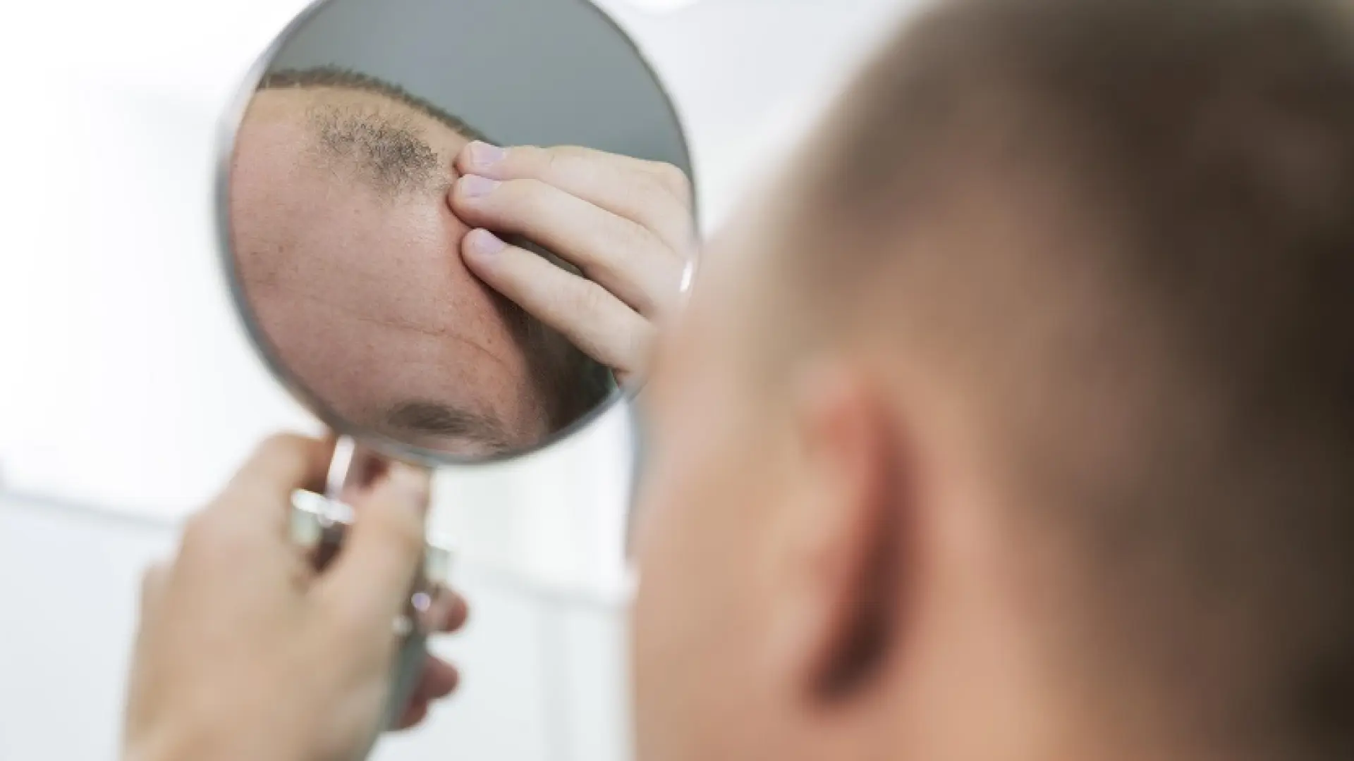 Efectos secundarios del minoxidil, el fármaco anticaída vinculado al 'síndrome del hombre lobo' en bebés