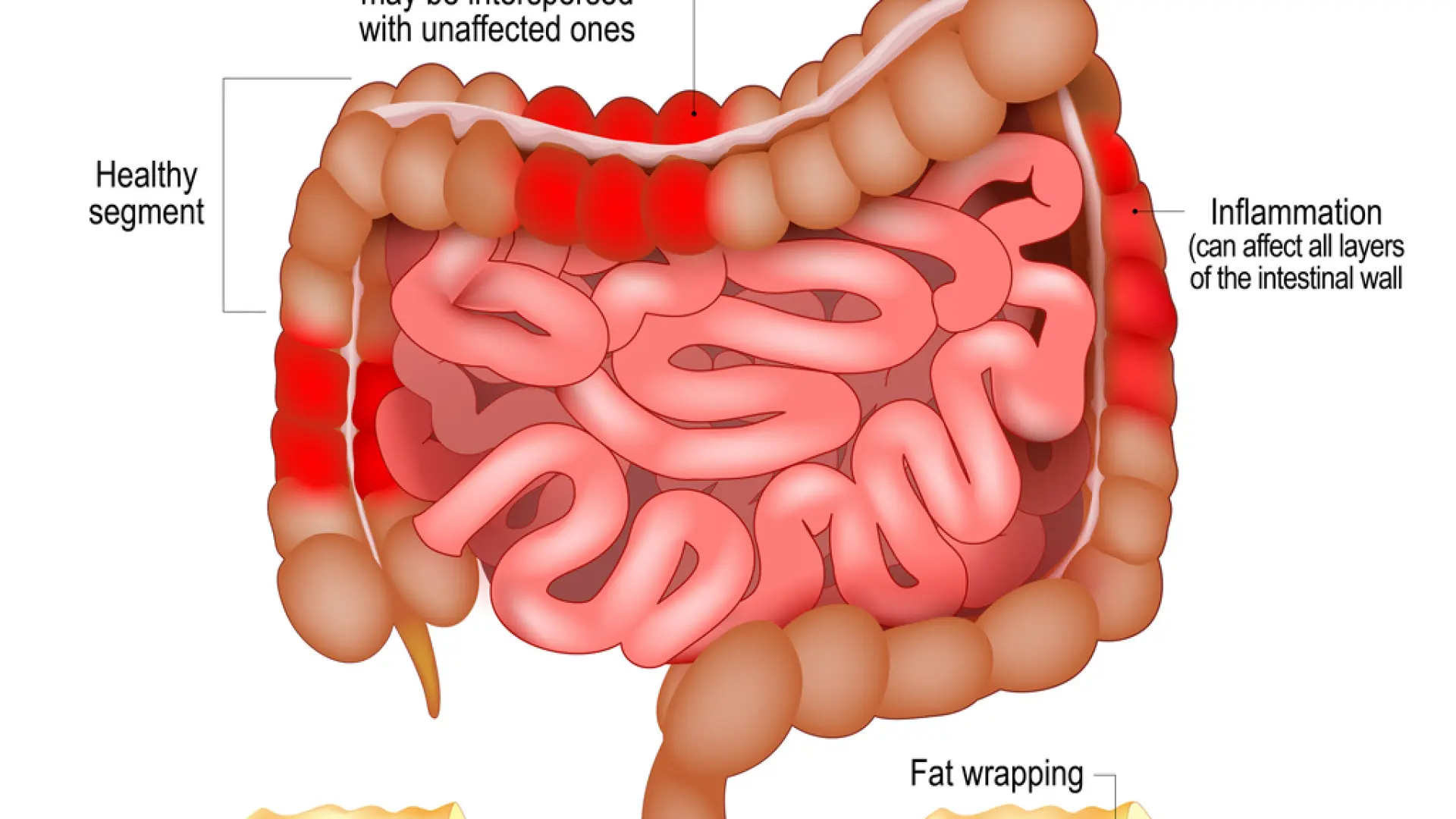 Así se manifiesta la enfermedad de Crohn: primeros síntomas a los que prestar atención