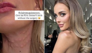 Modelo quería el cuello de Kris Jenner y se sometió a procedimiento estético que la dejó peor que antes