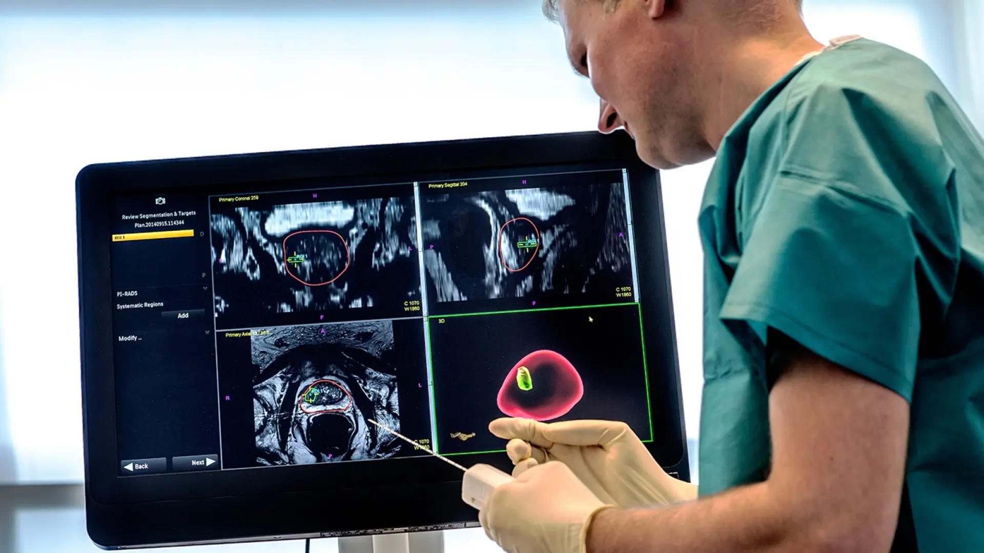 Los programas de cribado reducen el riesgo de muerte por cáncer de próstata en casi un 25%