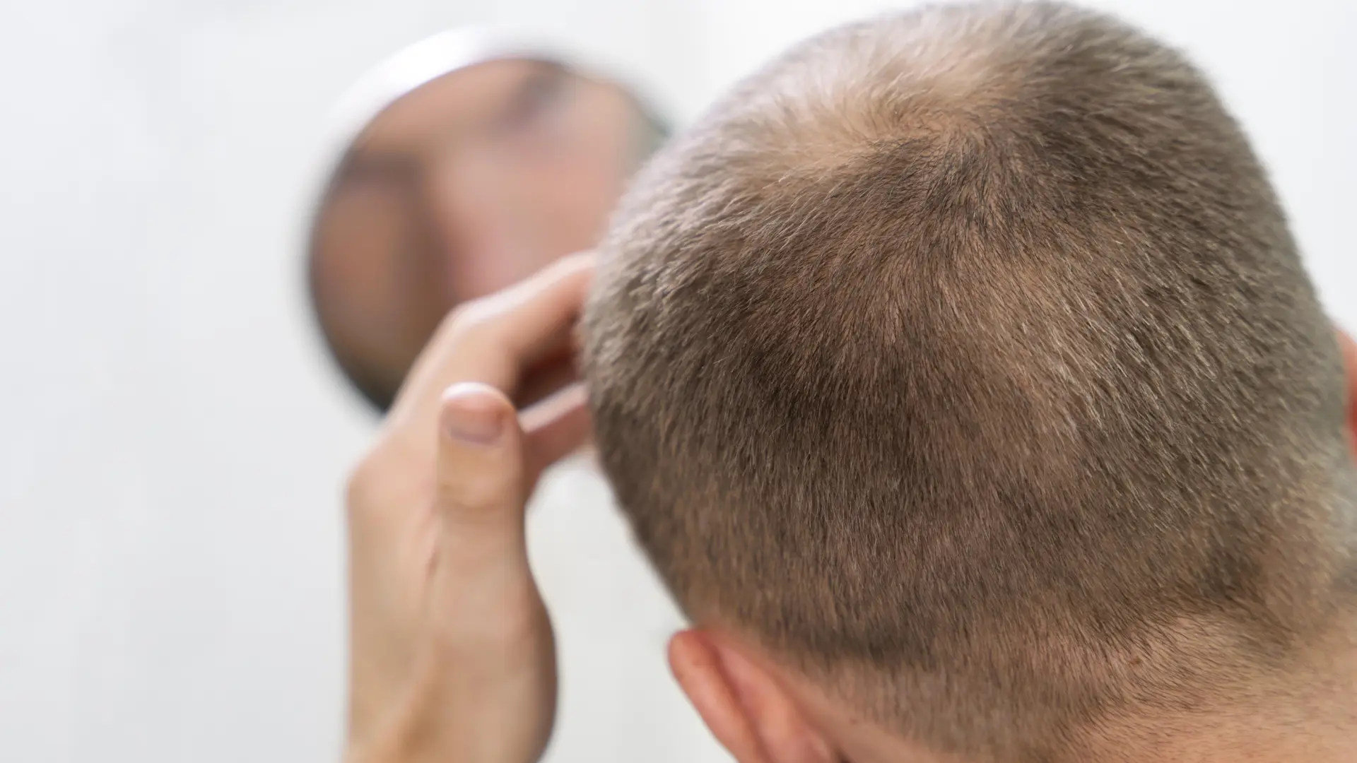Así es como afecta tu dieta a la alopecia