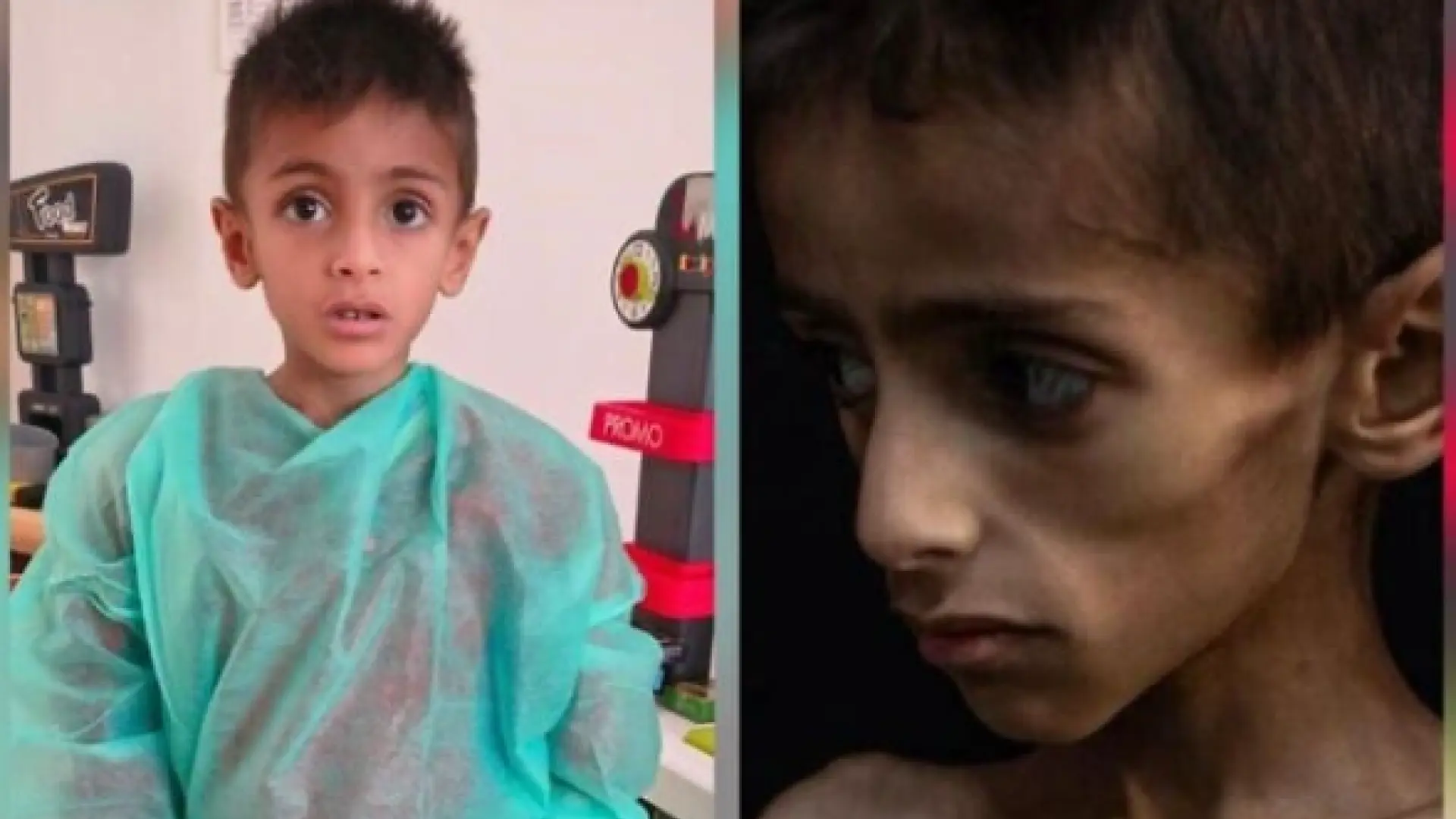 Israel denuncia que Hamás y los medios publican imágenes manipuladas de niños desnutridos: «Osama tiene una enfermedad genética»