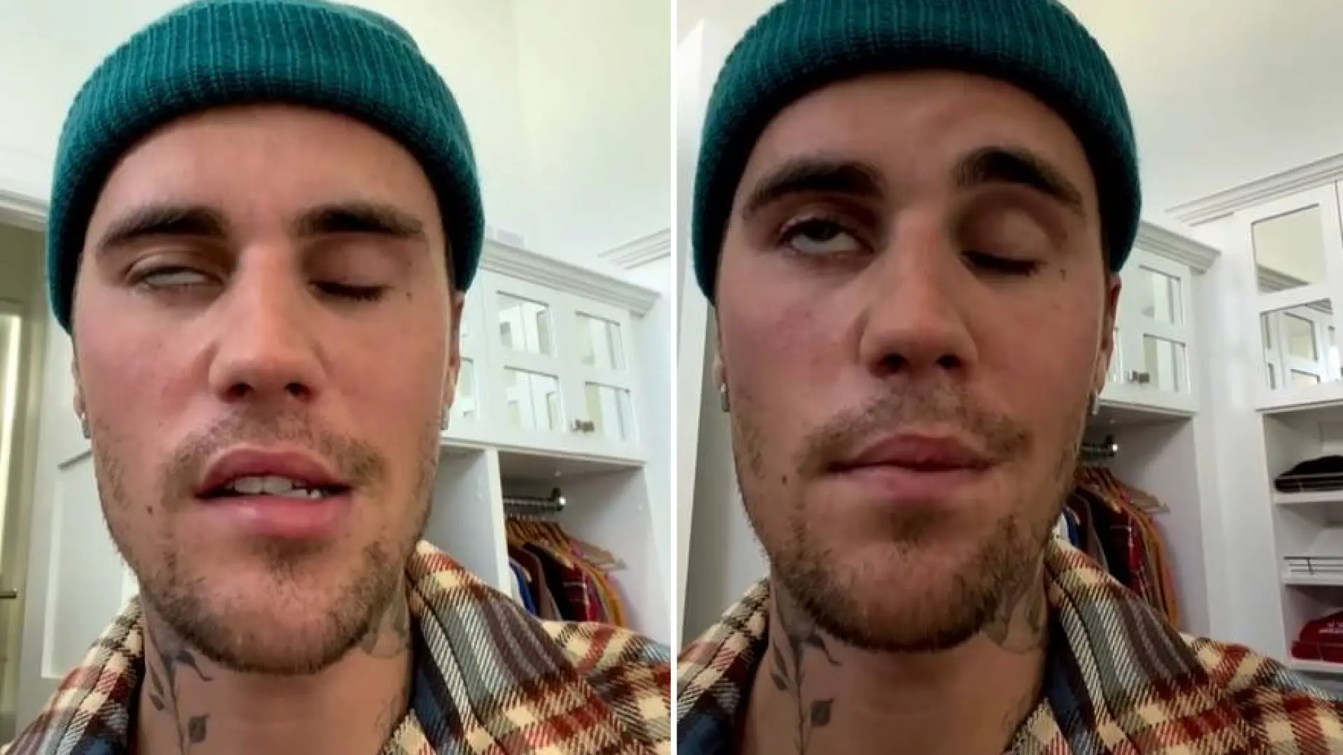 Qué es el síndrome de Ramsay Hunt, la enfermedad que sufrió Justin Bieber y que le paralizó media cara