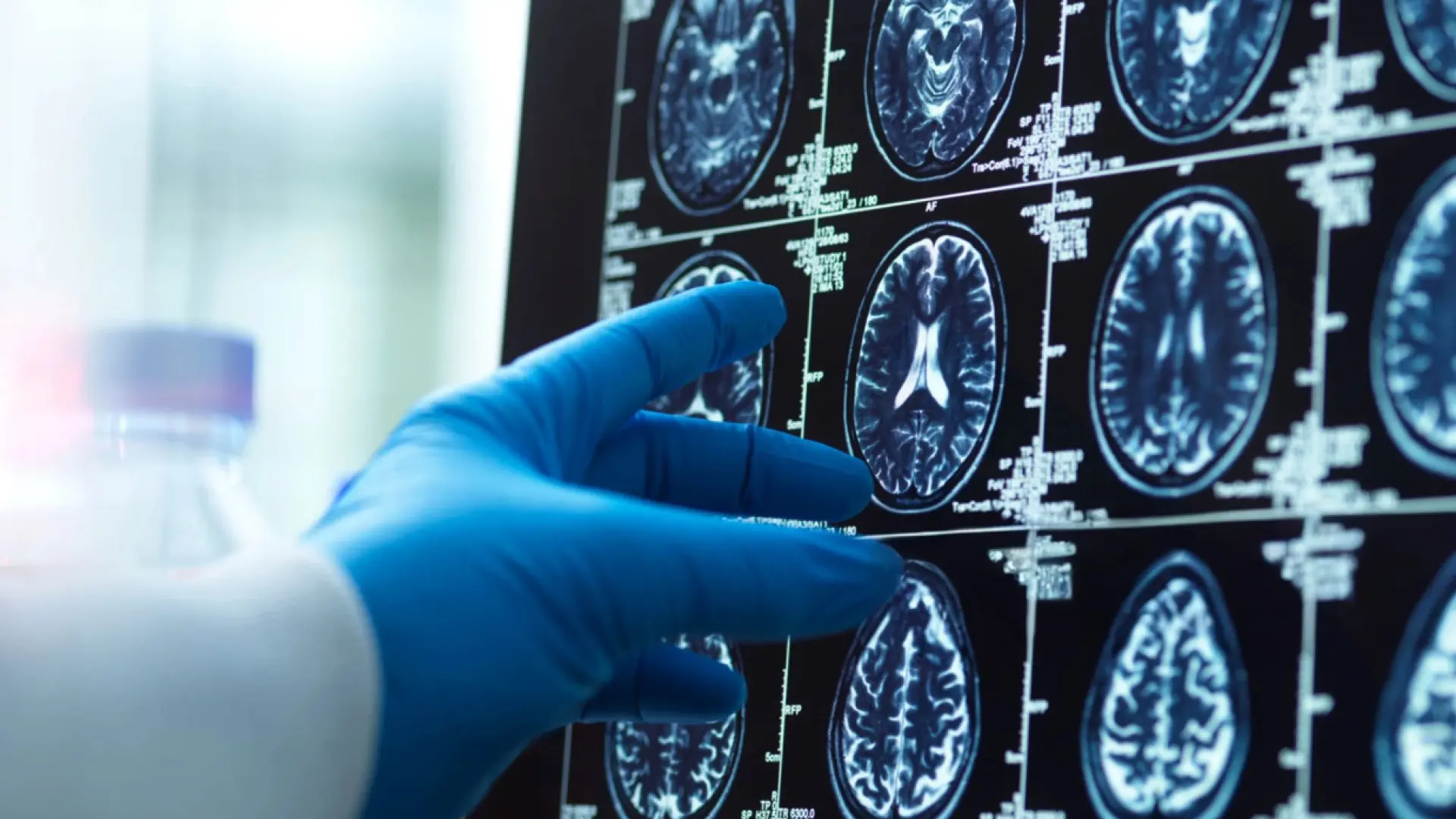 Investigadores españoles lideran la creación del primer atlas cerebral transdiagnóstico de los trastornos mentales