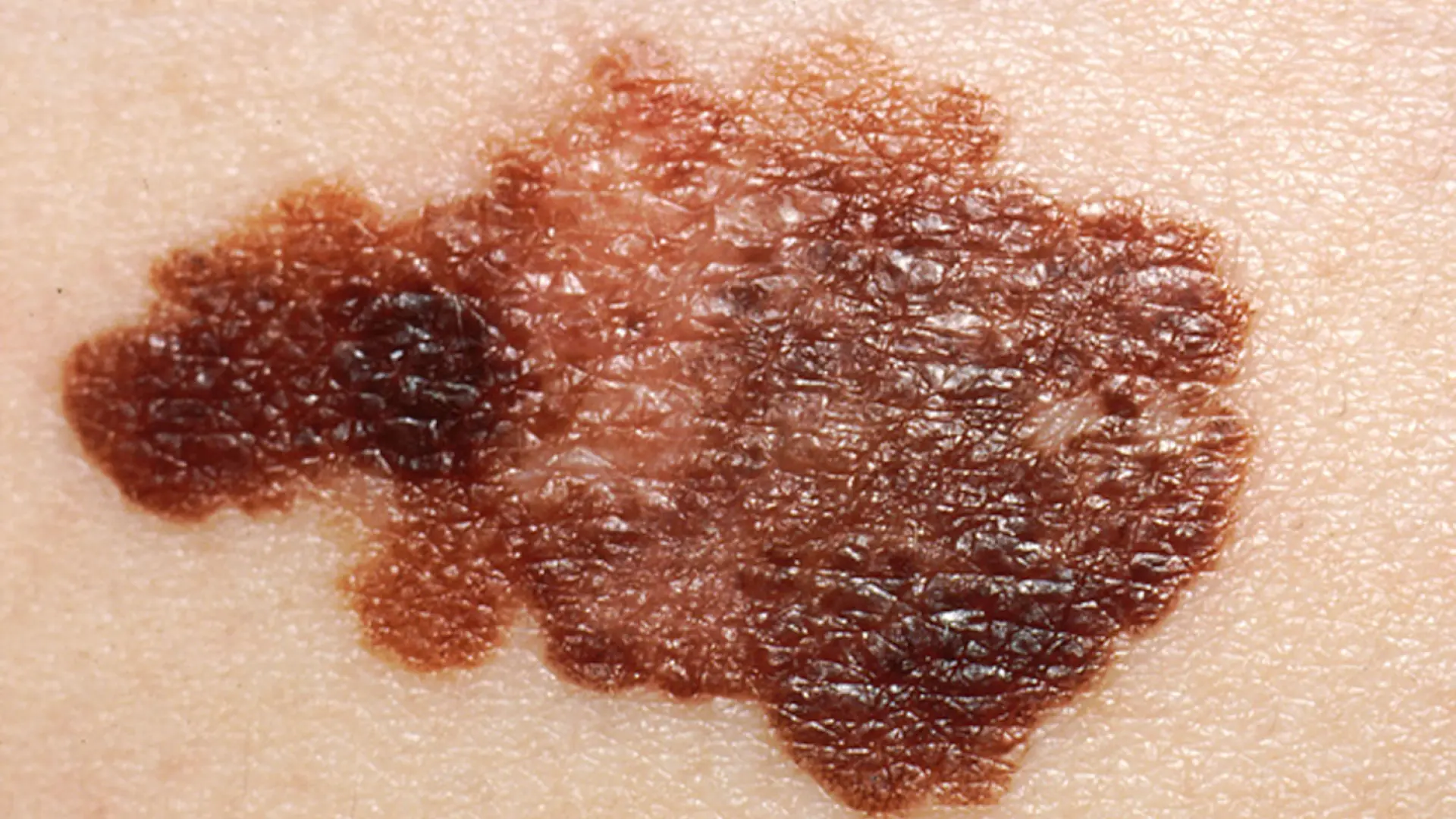 Científicos españoles descubren un 'GPS' del melanoma que podría ayudar a frenar la metástasis