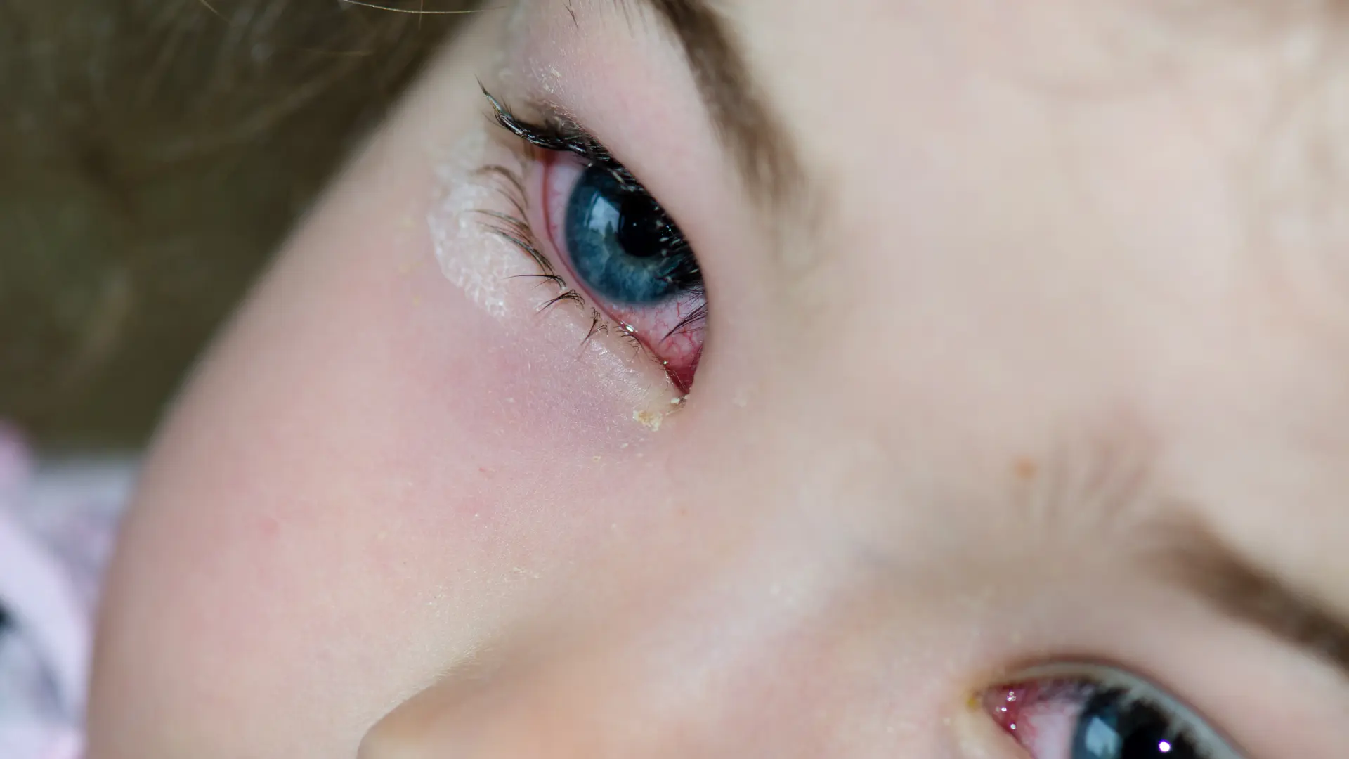 Piscinas y mar, un peligroso imán para la aparición de las temidas conjuntivitis