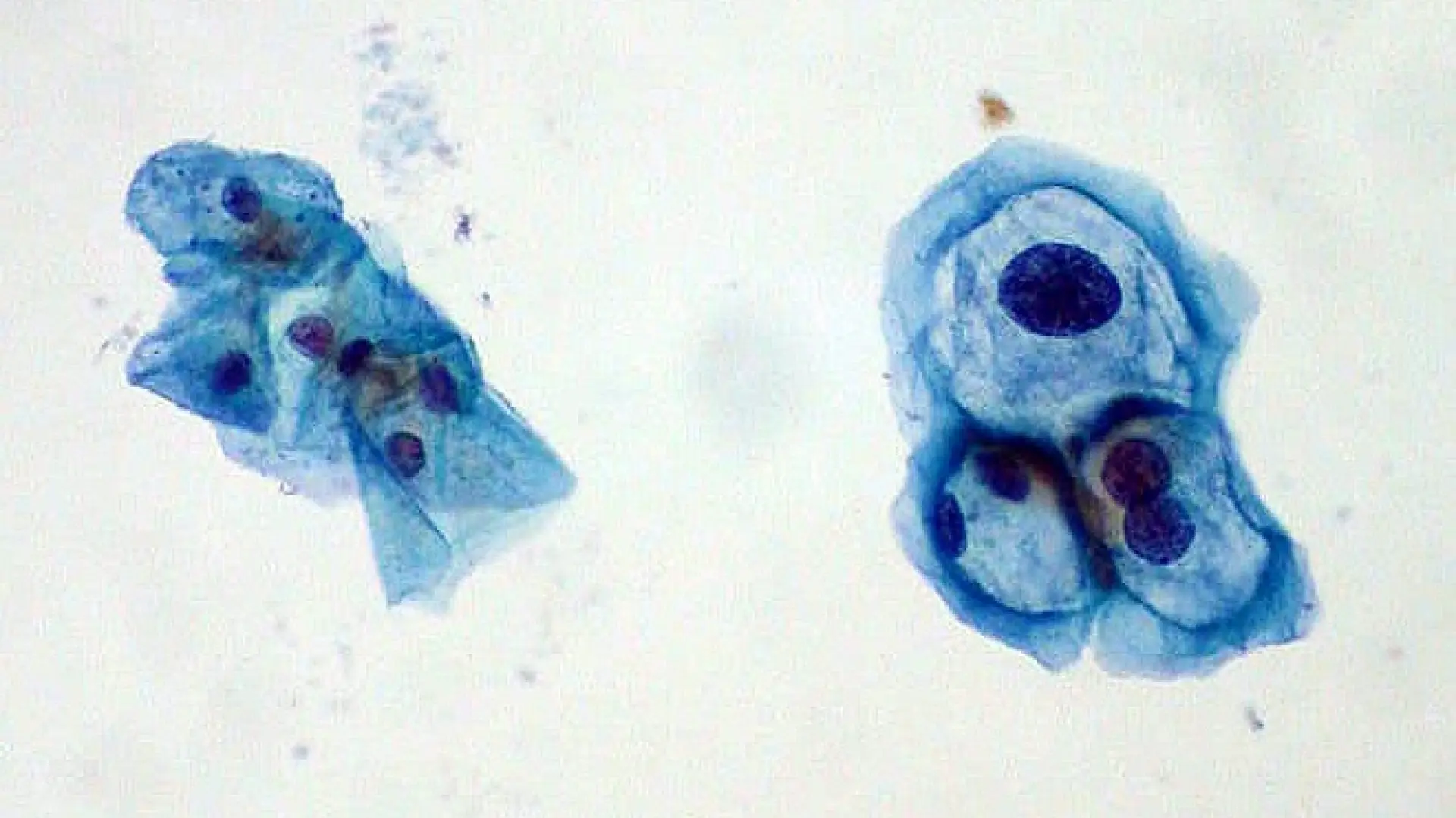 El virus que afecta a ocho de cada diez personas y puede derivar en cáncer años después